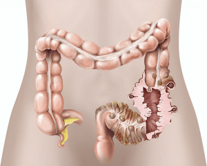 Lee más sobre el artículo Divertículos + Colitis = Diverticulitis