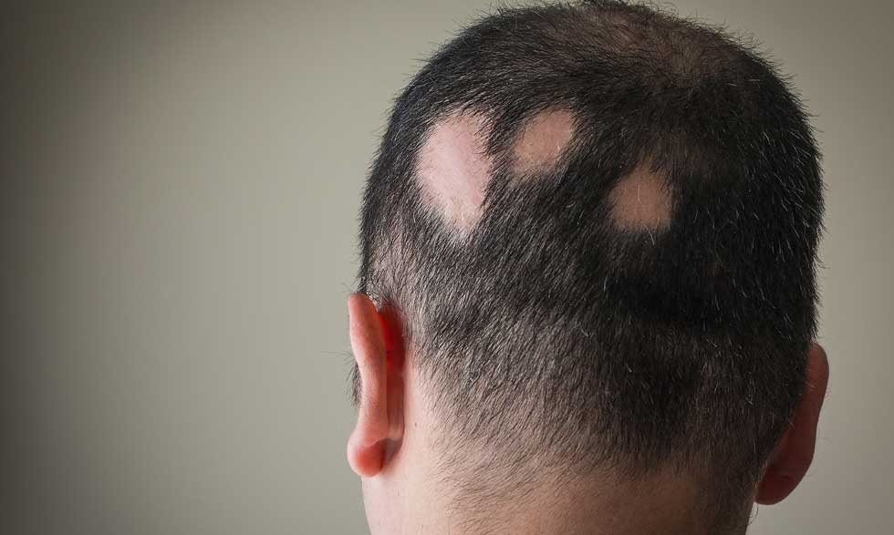 Lee más sobre el artículo Alopecia: ¿qué es, qué la causa y cómo se trata?